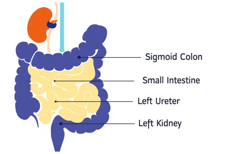 Pain in Lower Left Abdomen